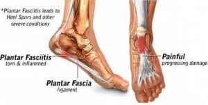 PLANTAR_FASCITIS0